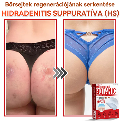 🔥✅ GFOUK® Mikrotűs növényi bőrkinövés eltávolító tapasz