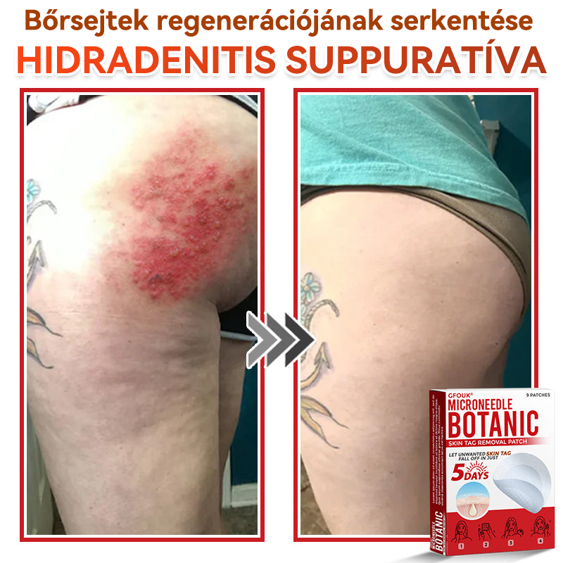 🎁 Már csak 5 csomag maradt! Most további 50% KEDVEZMÉNYT kaphatsz!  Segít láthatóan csökkenteni a bőrkinövéseket, szemölcsöket és egyéb bőrhibákat — gyorsan, kényelmesen és fájdalommentesen. 🌿