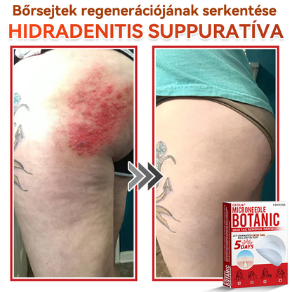 🔥✅ GFOUK® Mikrotűs növényi bőrkinövés eltávolító tapasz