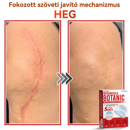 🎁 Már csak 5 csomag maradt! Most további 50% KEDVEZMÉNYT kaphatsz!  Segít láthatóan csökkenteni a bőrkinövéseket, szemölcsöket és egyéb bőrhibákat — gyorsan, kényelmesen és fájdalommentesen. 🌿