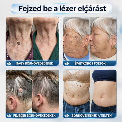 Hivatalos márkabolt | ✅🎉 Picdo® 7 napos bőrfütyök és folteltávolító (fájdalommentes, heg nélküli rollerball kezelés)