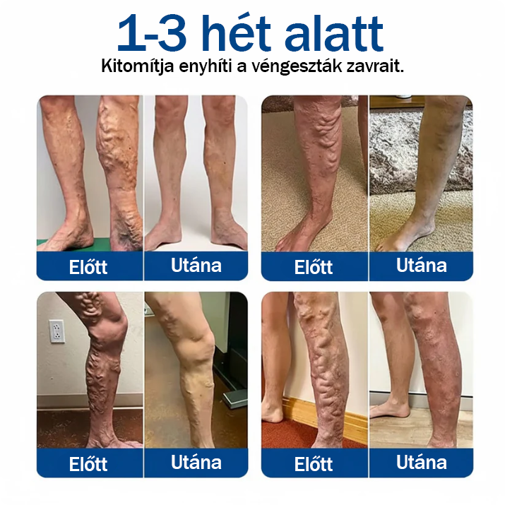❤️🇭🇺👨‍⚕️✅TAILEDEN® VeinEase Mikrotűs Kezelő Tapasz⚡Azonnali Megkönnyebbülés, Hosszú Távú Eredmények