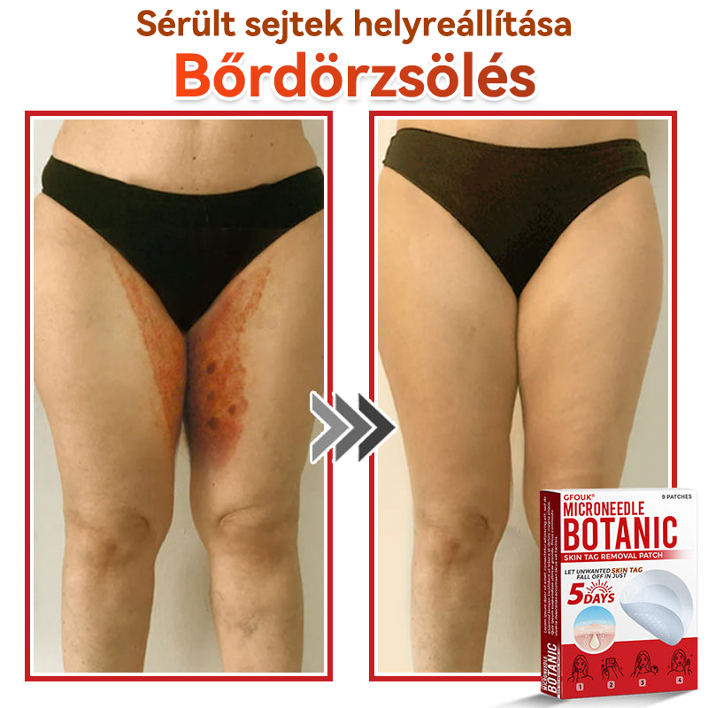 🎁 Már csak 5 csomag maradt! Most további 50% KEDVEZMÉNYT kaphatsz!  Segít láthatóan csökkenteni a bőrkinövéseket, szemölcsöket és egyéb bőrhibákat — gyorsan, kényelmesen és fájdalommentesen. 🌿