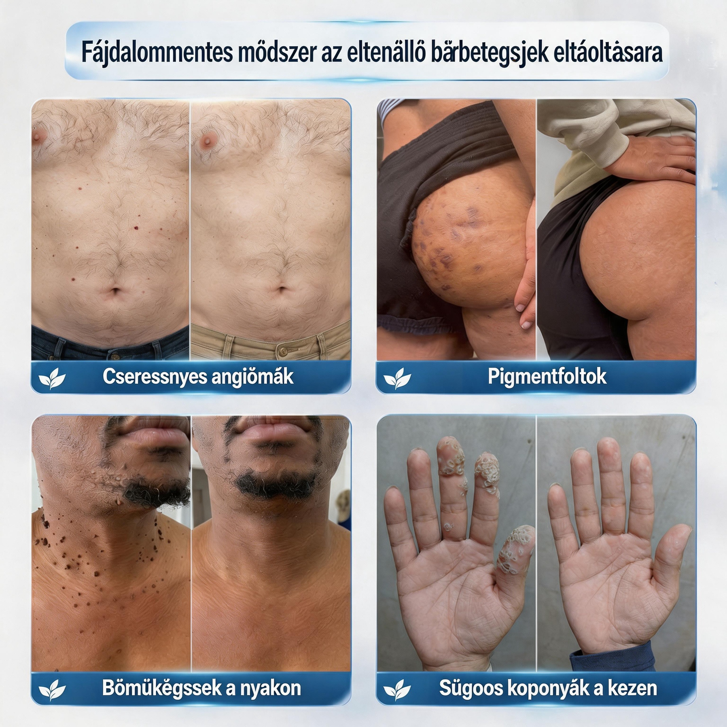 Hivatalos márkabolt | ✅🎉 Picdo® 7 napos bőrfütyök és folteltávolító (fájdalommentes, heg nélküli rollerball kezelés)