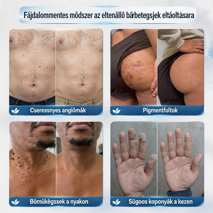 Hivatalos márkabolt | ✅🎉 Picdo® 7 napos bőrfütyök és folteltávolító (fájdalommentes, heg nélküli rollerball kezelés)