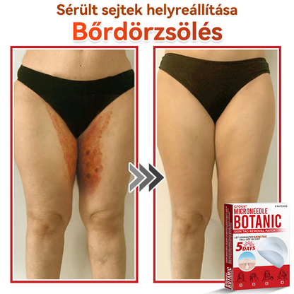 🔥✅ GFOUK® Mikrotűs növényi bőrkinövés eltávolító tapasz