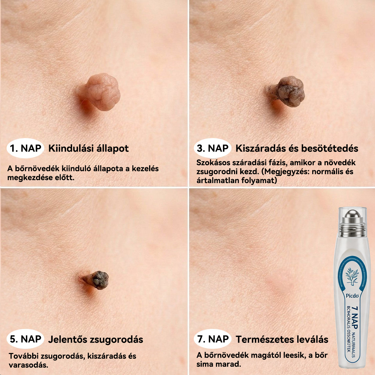 Hivatalos márkabolt | ✅🎉 Picdo® 7 napos bőrfütyök és folteltávolító (fájdalommentes, heg nélküli rollerball kezelés)