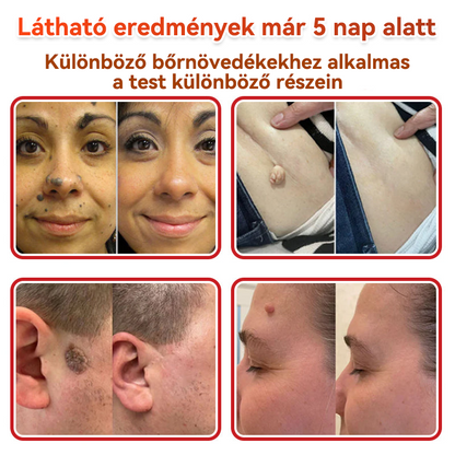 🔥✅ GFOUK® Mikrotűs növényi bőrkinövés eltávolító tapasz