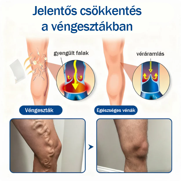 ❤️🇭🇺👨‍⚕️✅TAILEDEN® VeinEase Mikrotűs Kezelő Tapasz⚡Azonnali Megkönnyebbülés, Hosszú Távú Eredmények