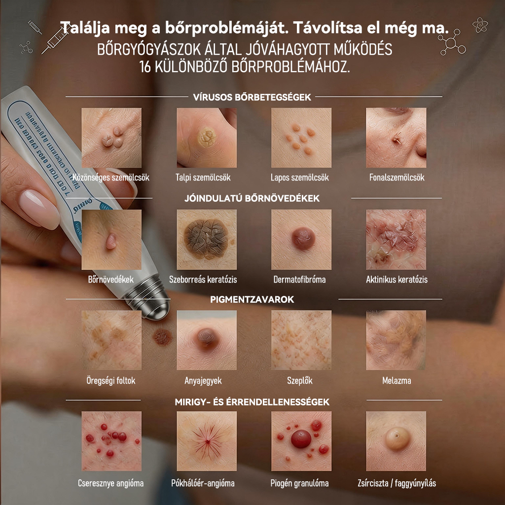Hivatalos márkabolt | ✅🎉 Picdo® 7 napos bőrfütyök és folteltávolító (fájdalommentes, heg nélküli rollerball kezelés)