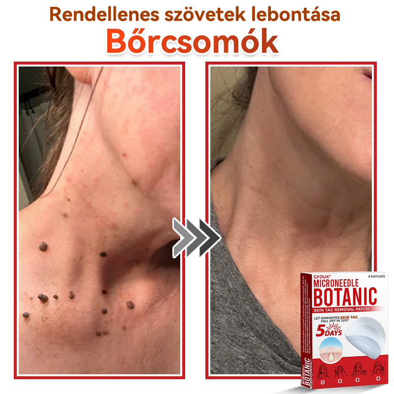 🎁 Már csak 5 csomag maradt! Most további 50% KEDVEZMÉNYT kaphatsz!  Segít láthatóan csökkenteni a bőrkinövéseket, szemölcsöket és egyéb bőrhibákat — gyorsan, kényelmesen és fájdalommentesen. 🌿