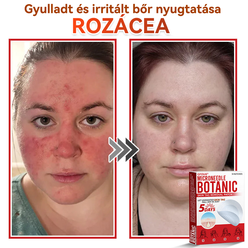 🔥✅ GFOUK® Mikrotűs növényi bőrkinövés eltávolító tapasz