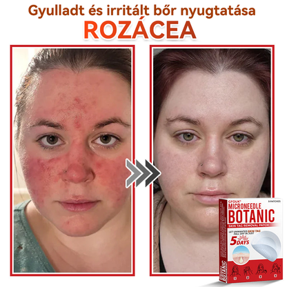 🔥✅ GFOUK® Mikrotűs növényi bőrkinövés eltávolító tapasz