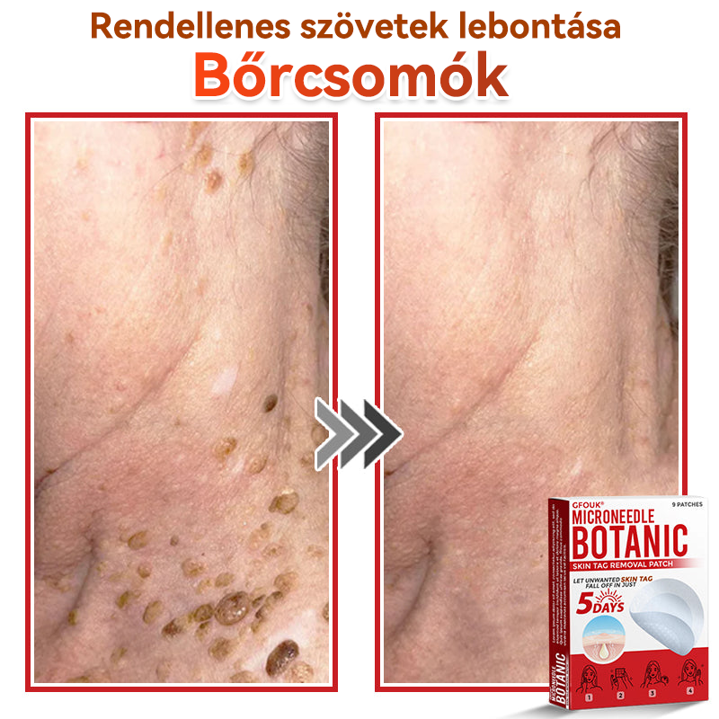 🔥✅ GFOUK® Mikrotűs növényi bőrkinövés eltávolító tapasz