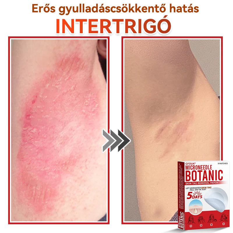 🎁 Már csak 5 csomag maradt! Most további 50% KEDVEZMÉNYT kaphatsz!  Segít láthatóan csökkenteni a bőrkinövéseket, szemölcsöket és egyéb bőrhibákat — gyorsan, kényelmesen és fájdalommentesen. 🌿